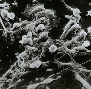 Treatments for Advanced Liver Cancer
